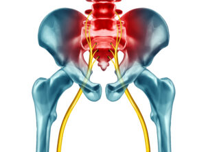 Compression fracture causing sciatic nerve pain