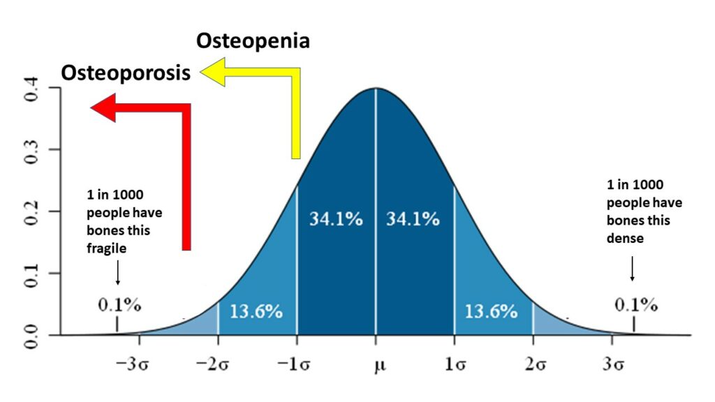 Graph showing bone density scores of osteopenia and osteoporosis