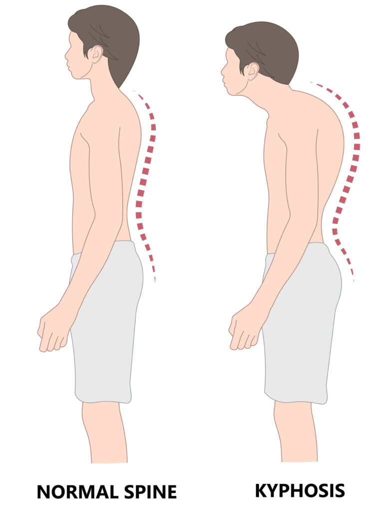 Image of hyperkyphosis
